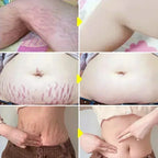 Cream For Pregnancy Stretch Marks Removal Eliminate Red White Old Stretch Marks 26