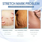 Cream For Pregnancy Stretch Marks Removal Eliminate Red White Old Stretch Marks 26
